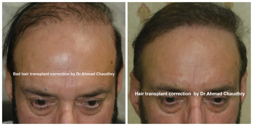 Hair transplant repair in Lahore Pakistan 