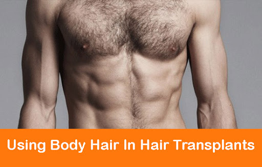 Body hair to head transplant in Pakistan