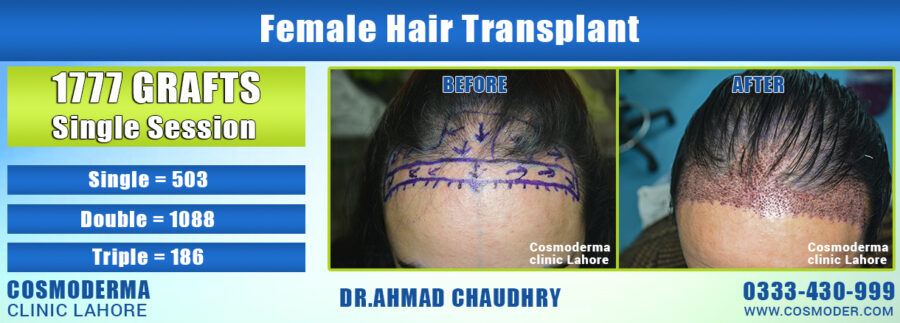 Female hair transplant in Pakistan | Women hair loss treatment | call us