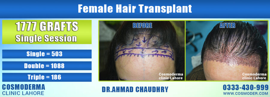 Female hair transplant in Pakistan