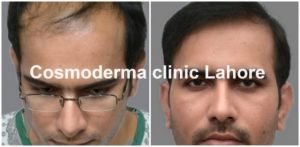 Front-hairline-clinic-lahore-Pakistan