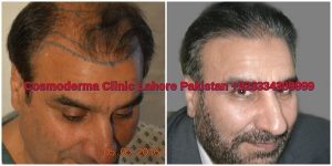 Fue-hair-transplant-clinic-lahore-results-3000-grafts
