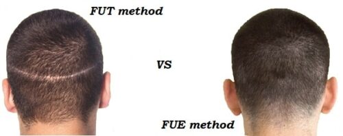 Why Fue Hair Transplant Is Preferred over FUT hair restoration