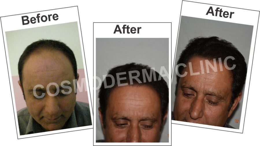 cheap-hair-transplant-in-Lahore