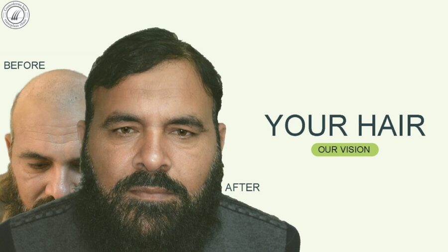 fue-hair-transplant-Lahore-pakistan-min