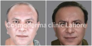 Combo hair transplant