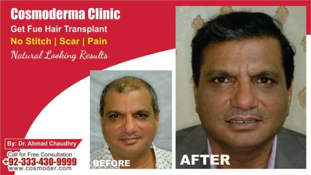 Hair transplant surgery clinic in Lahore Pakistan | Best surgeon result