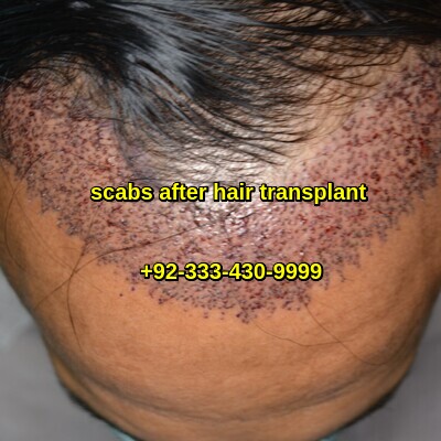 scabs after hair transplant