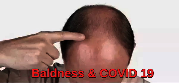 Baldness and covid 19 relation