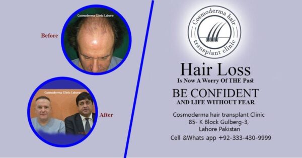 Hair loss baldness treatment Lahore Pakistan