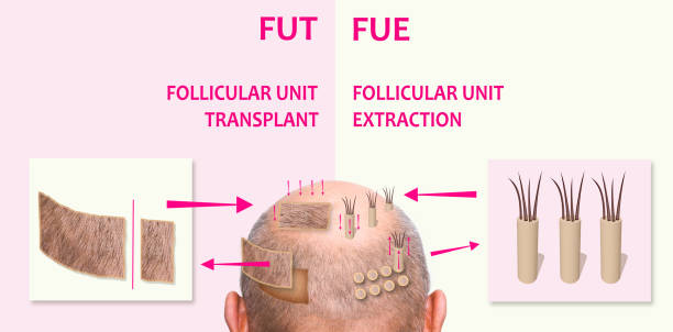 Hair restoration techniques