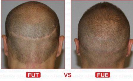 Difference-Between-FUE-and-FUT-Hair-Transplant-Pakistan