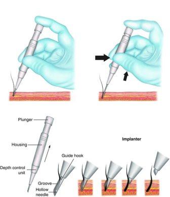 Direct hair implant clinic Lahore Pakistan