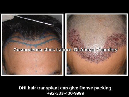 Direct hair implant technique Pakistan