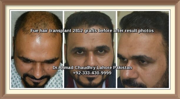 Top hair transplant clinic results Pakistan