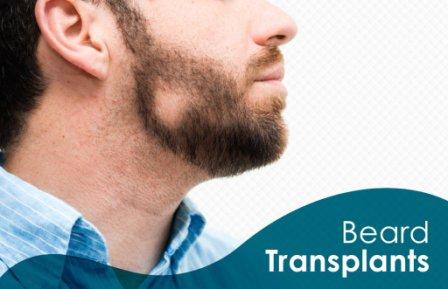 beard hair transplant Pakistan