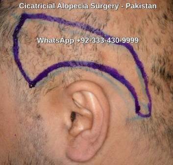 Cicatricial alopecia surgery Pakistan