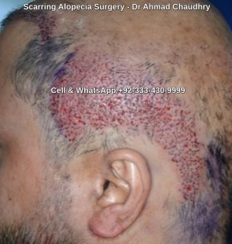 Cicatricial alopecia surgery clinic Pakistan