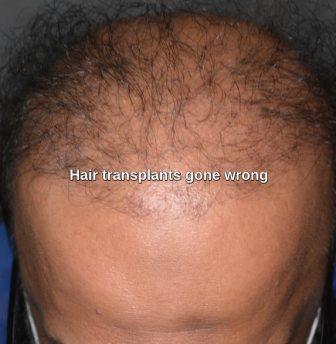 Failed hair restoration surgery results