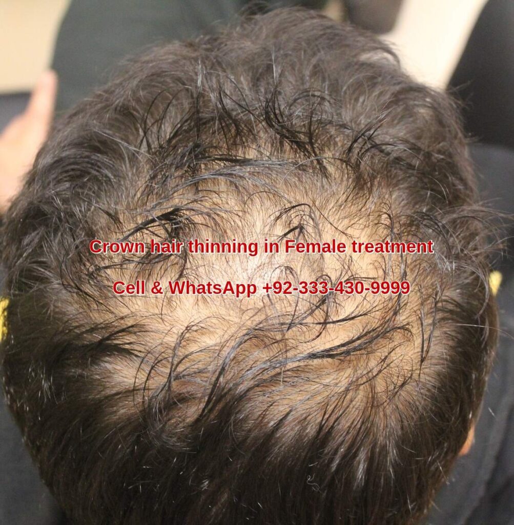 Female hair thinning at crown