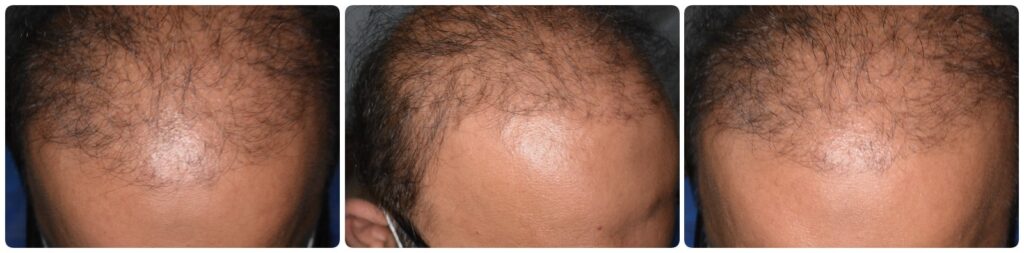 Hair transplant gone wrong in Pakistan