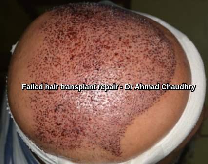 Repair or fixing bad hair transplant in Pakistan