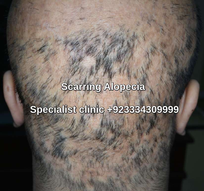 Scarring Alopecia clinic Lahore Pakistan