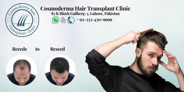 4000 grafts hair transplant cost in Pakistan | Best specialist clinic