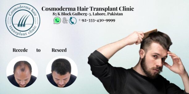 4000 grafts hair transplant cost Pakistan