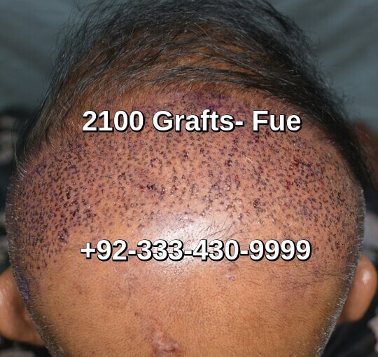 2100 grafts first post op day in Pakistan
