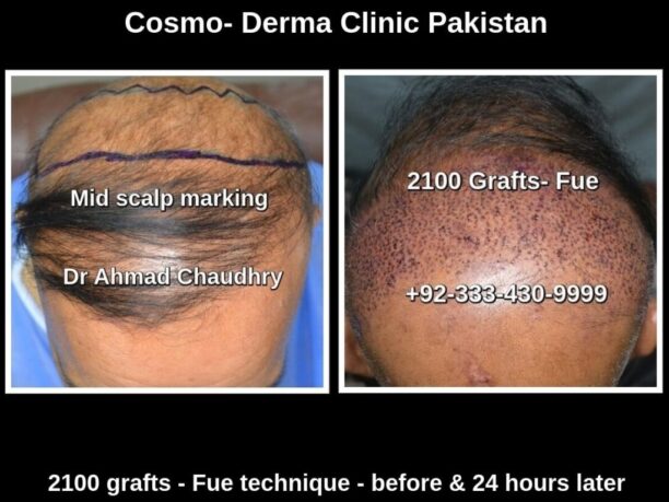 2100 grafts hair transplant Pakistan