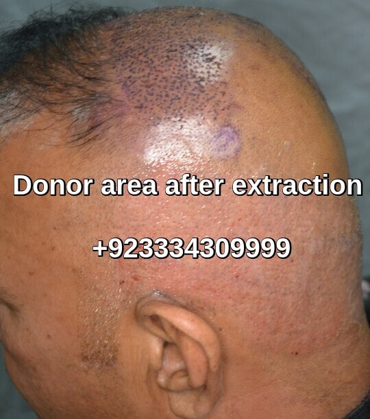 Fue donor area after 2100 grafts extraction