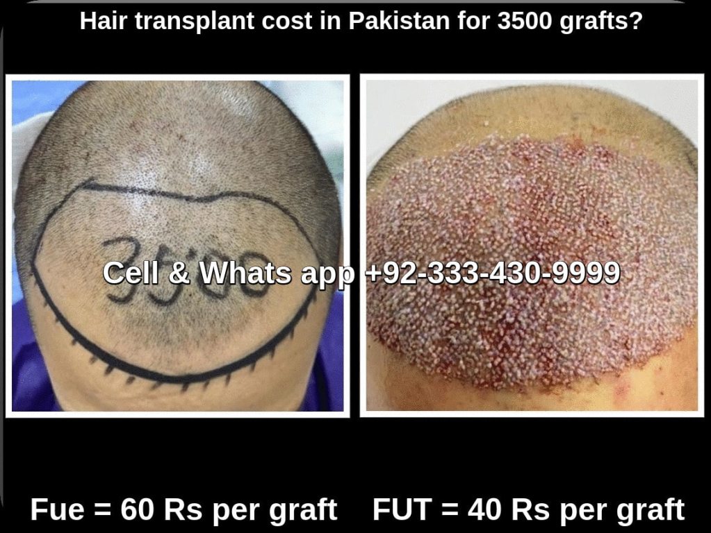 Hair transplant cost Pakistan