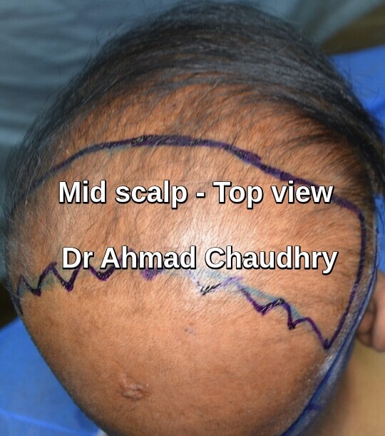 Mid scalp hair restoration top view