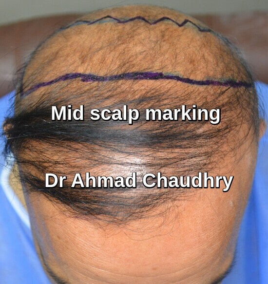 Mid scalp marking before procedure