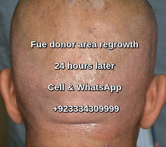 Fue hair transplant donor area