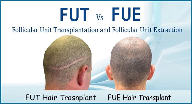 Fue-vs-fut hair transplant scar