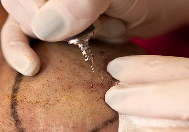 Cheap Fue hair transplant destination