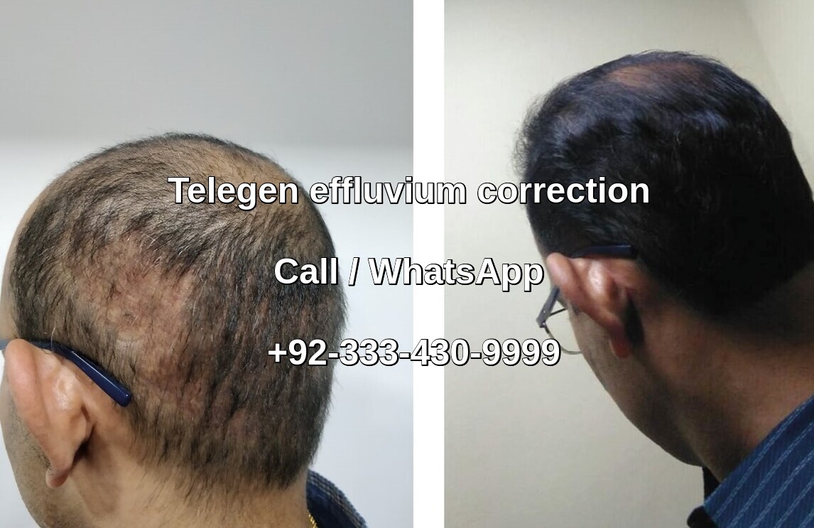 Donor area telogen effluvium correction Pakistan