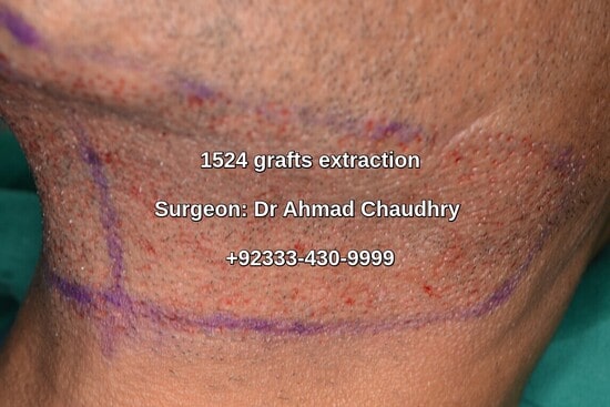 1524 beard grafts extraction Lahore Pakistan