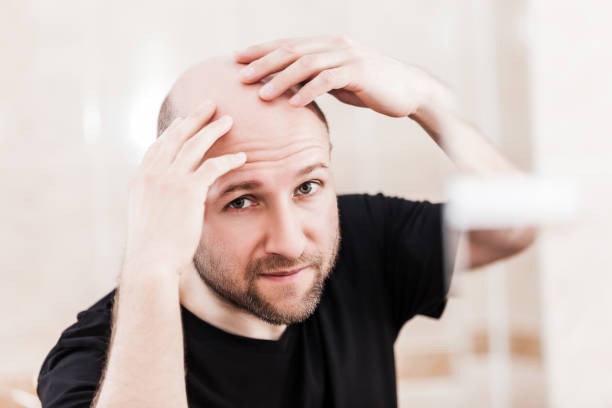 Baldness treatments options