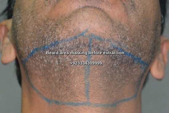 Beard area marking before Fue extraction