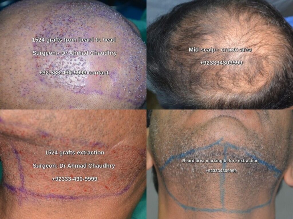 Beard hair extraction 1524 grafts for head Pakistan