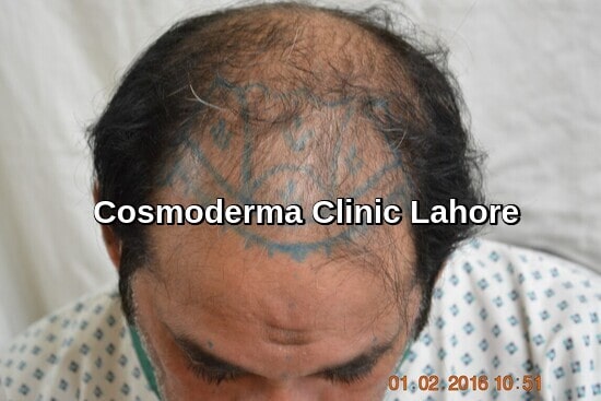 First session hair transplant designing