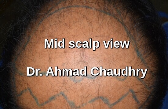 Mid scalp back view before