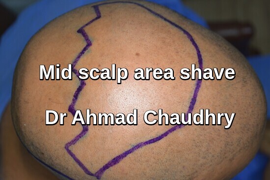 Shave before Fue procedure