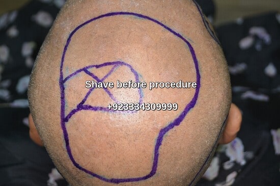 Shave plus marking before hair transplant Pakistan