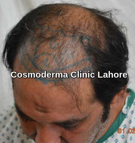 front part head hair restoration