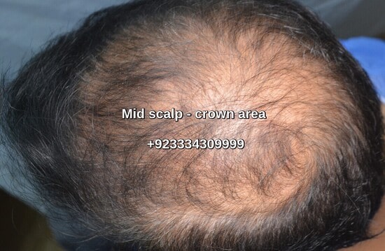mid scalp crown before-min