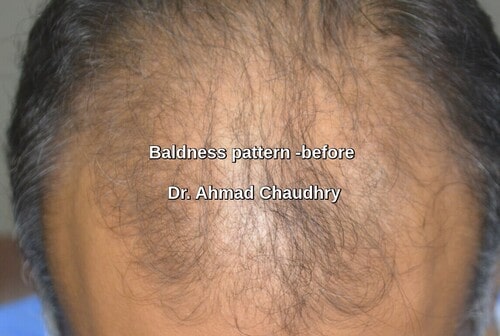 Baldness before photos Sheikhupura patient
